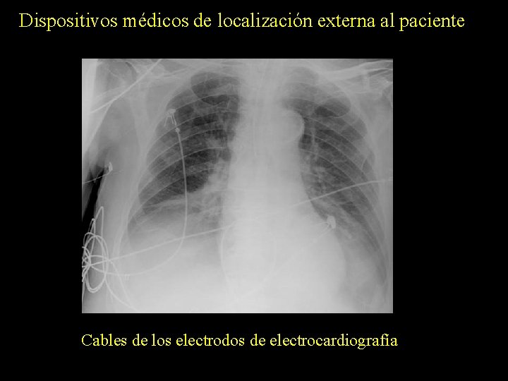 Dispositivos médicos de localización externa al paciente Cables de los electrodos de electrocardiografía 