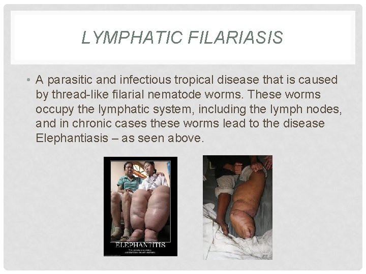 LYMPHATIC FILARIASIS • A parasitic and infectious tropical disease that is caused by thread-like