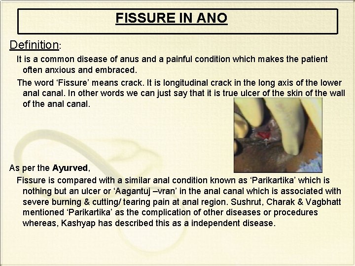 FISSURE IN ANO Definition: It is a common disease of anus and a painful