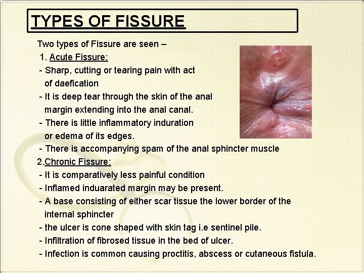 TYPES OF FISSURE Two types of Fissure are seen – 1. Acute Fissure: -