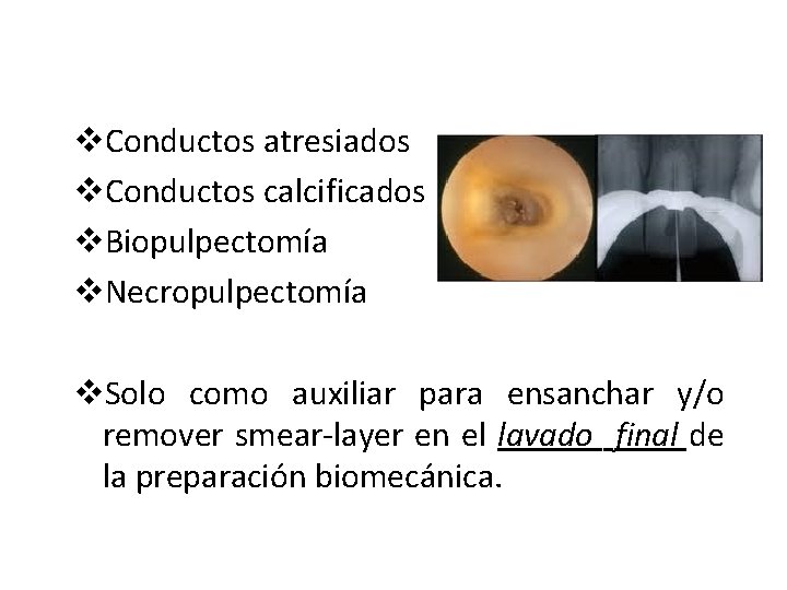 v. Conductos atresiados v. Conductos calcificados v. Biopulpectomía v. Necropulpectomía v. Solo como auxiliar v. Conductos atresiados v. Conductos calcificados v. Biopulpectomía v. Necropulpectomía v. Solo como auxiliar