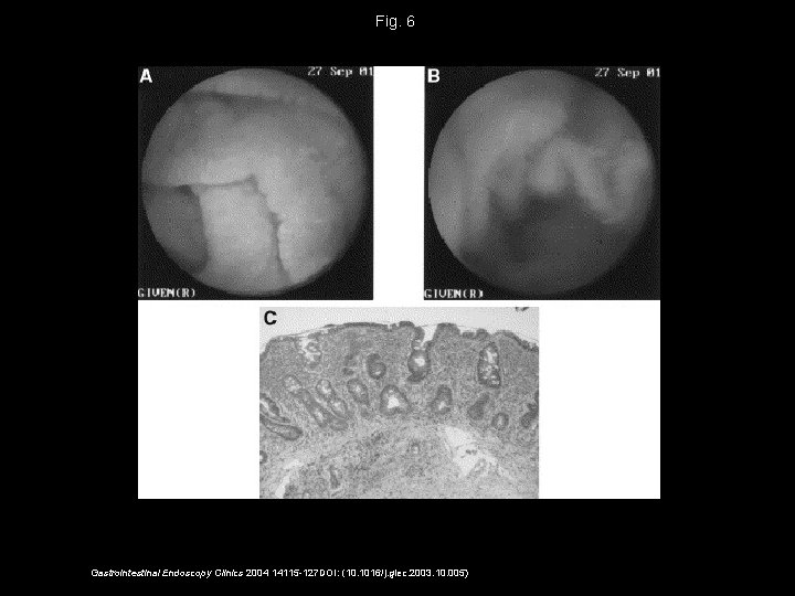 Fig. 6 Gastrointestinal Endoscopy Clinics 2004 14115 -127 DOI: (10. 1016/j. giec. 2003. 10.