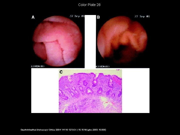 Color Plate 28 Gastrointestinal Endoscopy Clinics 2004 14115 -127 DOI: (10. 1016/j. giec. 2003.