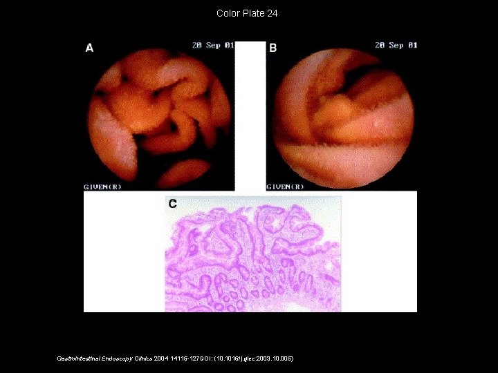 Color Plate 24 Gastrointestinal Endoscopy Clinics 2004 14115 -127 DOI: (10. 1016/j. giec. 2003.