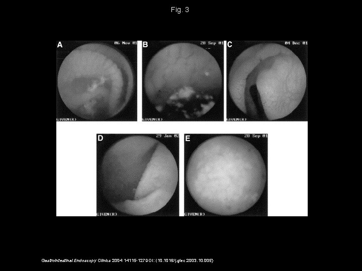 Fig. 3 Gastrointestinal Endoscopy Clinics 2004 14115 -127 DOI: (10. 1016/j. giec. 2003. 10.