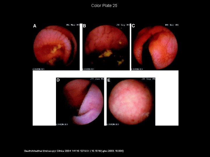Color Plate 25 Gastrointestinal Endoscopy Clinics 2004 14115 -127 DOI: (10. 1016/j. giec. 2003.