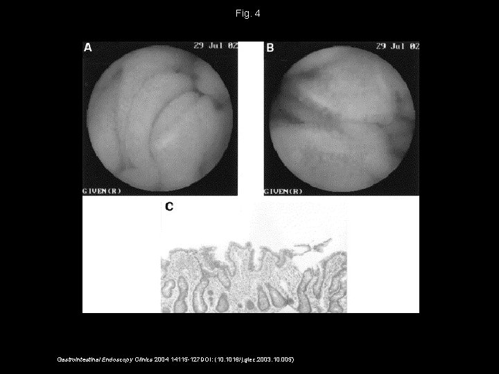 Fig. 4 Gastrointestinal Endoscopy Clinics 2004 14115 -127 DOI: (10. 1016/j. giec. 2003. 10.