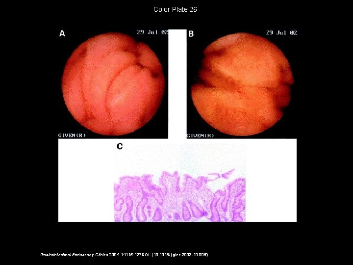 Color Plate 26 Gastrointestinal Endoscopy Clinics 2004 14115 -127 DOI: (10. 1016/j. giec. 2003.