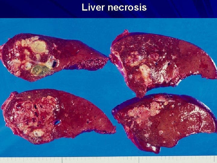 Liver necrosis 