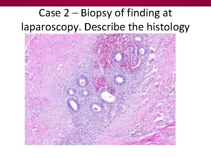 Case 2 – Biopsy of finding at laparoscopy. Describe the histology 