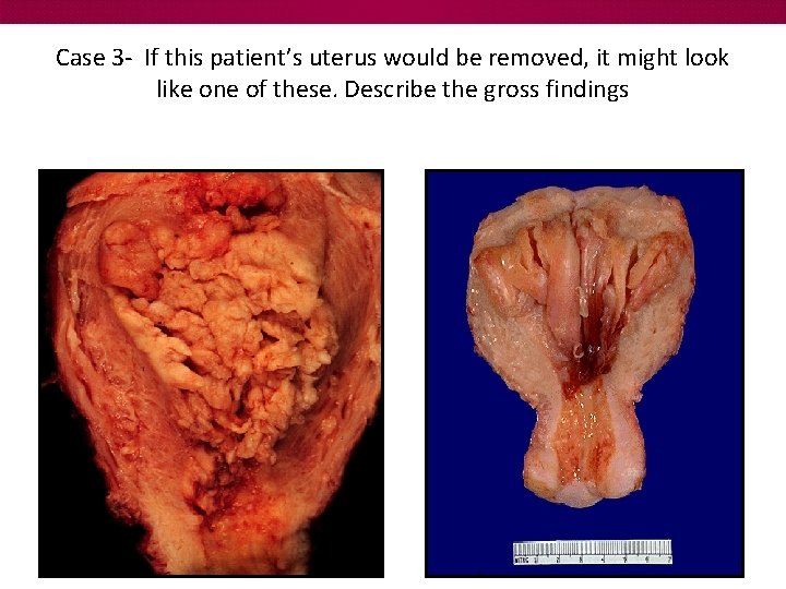 Case 3 - If this patient’s uterus would be removed, it might look like