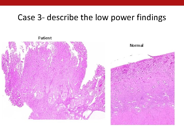 Case 3 - describe the low power findings Patient Normal 