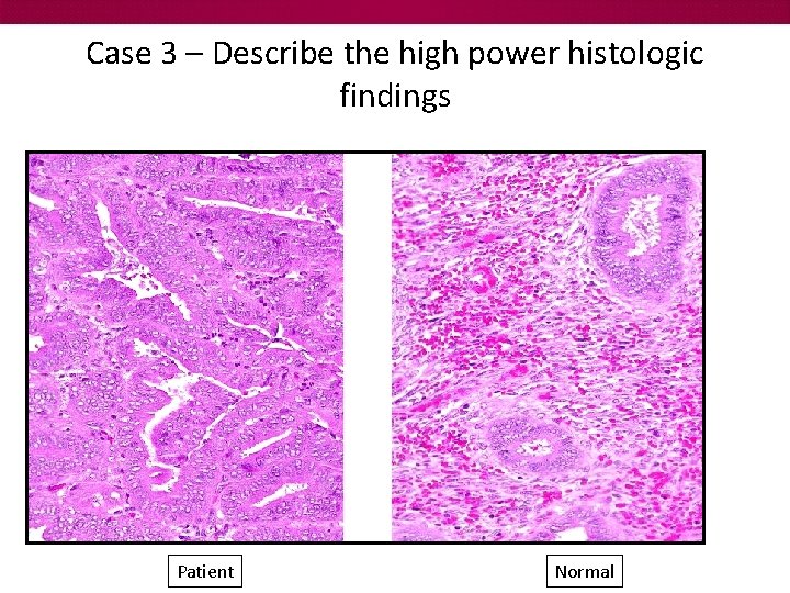 Case 3 – Describe the high power histologic findings Patient Normal 
