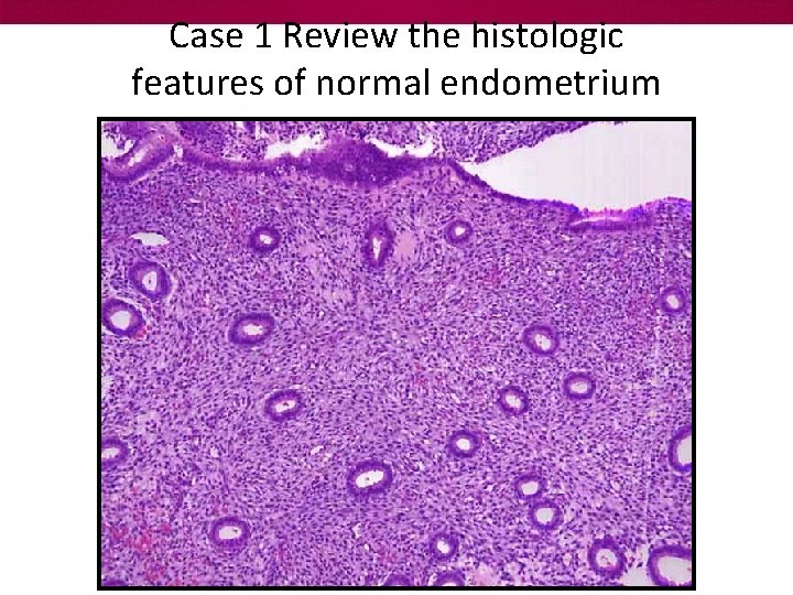 Case 1 Review the histologic features of normal endometrium 
