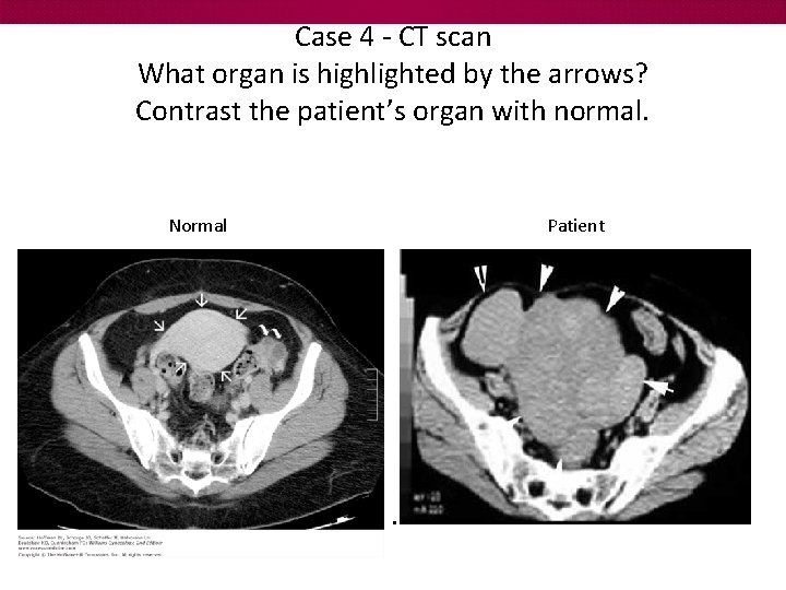 Case 4 - CT scan What organ is highlighted by the arrows? Contrast the