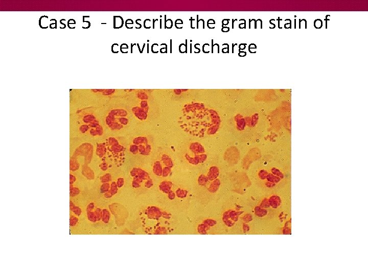 Case 5 - Describe the gram stain of cervical discharge 