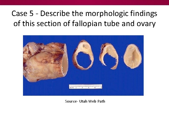 Case 5 - Describe the morphologic findings of this section of fallopian tube and
