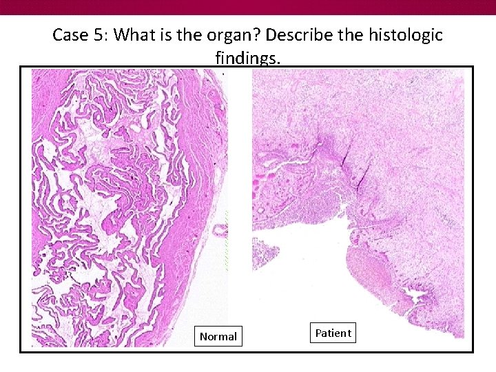 Case 5: What is the organ? Describe the histologic findings. Normal Patient 