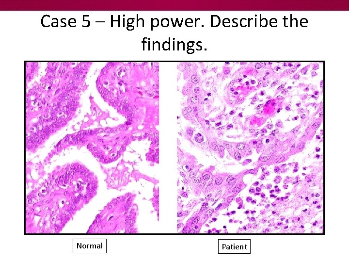 Case 5 – High power. Describe the findings. Normal Patient 