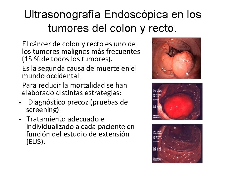 Ultrasonografía Endoscópica en los tumores del colon y recto. El cáncer de colon y