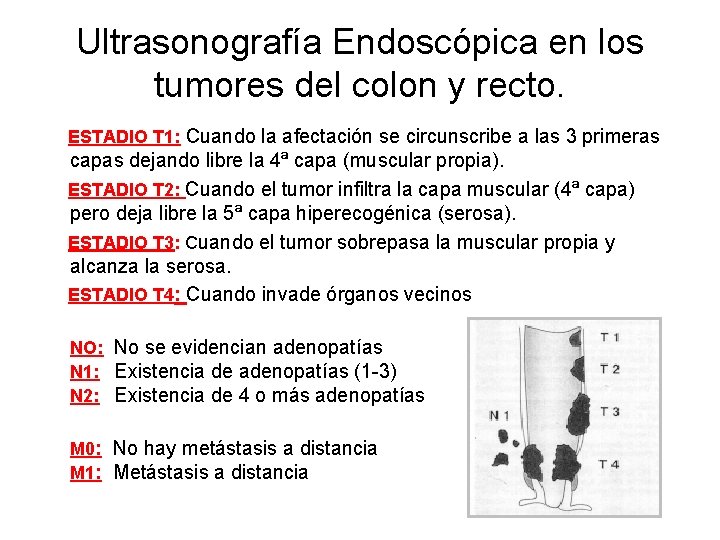 Ultrasonografía Endoscópica en los tumores del colon y recto. ESTADIO T 1: Cuando la