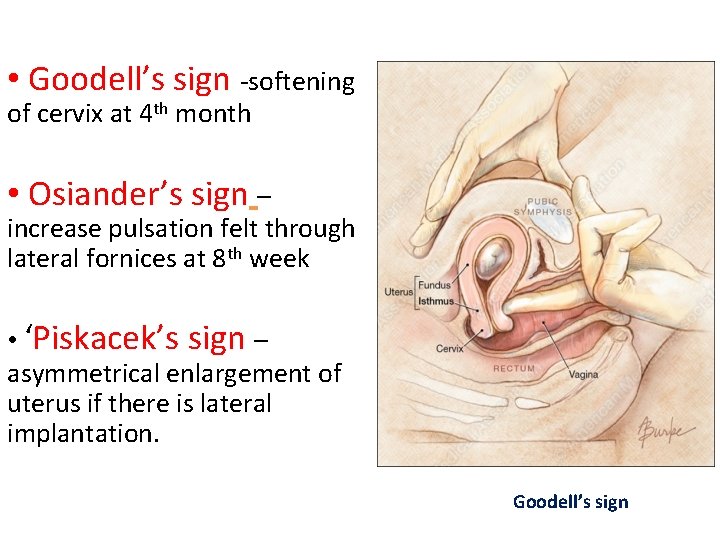  • Goodell’s sign -softening of cervix at 4 th month • Osiander’s sign