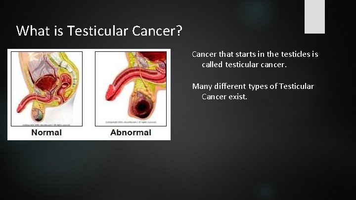 What is Testicular Cancer? Cancer that starts in the testicles is called testicular cancer.