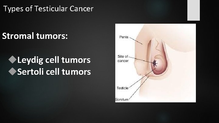 Types of Testicular Cancer Stromal tumors: Leydig cell tumors Sertoli cell tumors 