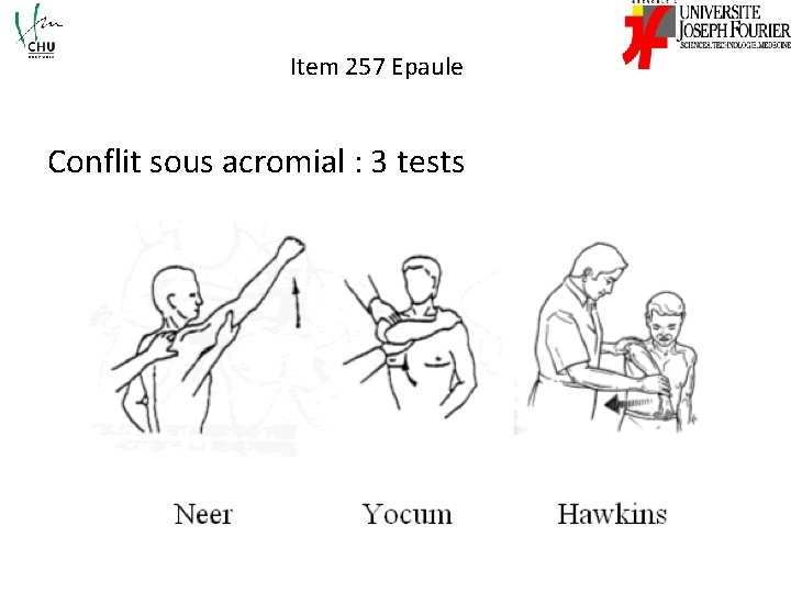 Item 257 Epaule Conflit sous acromial : 3 tests 