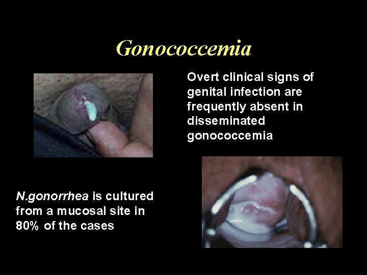 Gonococcemia Overt clinical signs of genital infection are frequently absent in disseminated gonococcemia N.