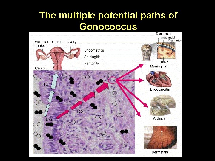 The multiple potential paths of Gonococcus 