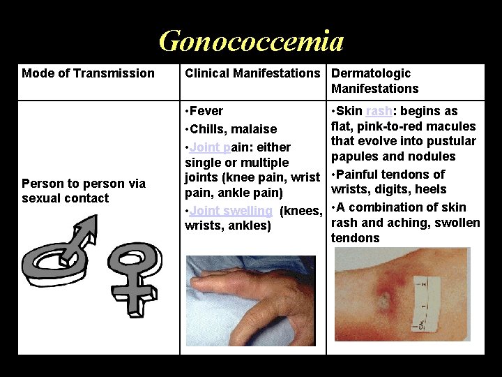 Gonococcemia Mode of Transmission Person to person via sexual contact Clinical Manifestations Dermatologic Manifestations