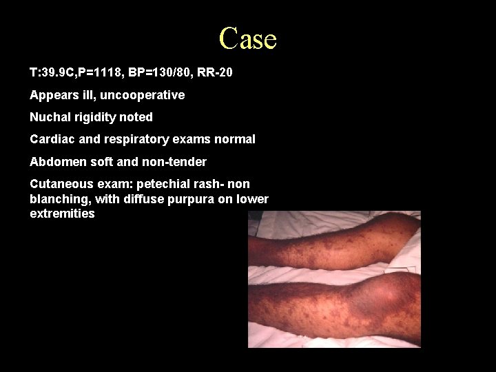 Case T: 39. 9 C, P=1118, BP=130/80, RR-20 Appears ill, uncooperative Nuchal rigidity noted