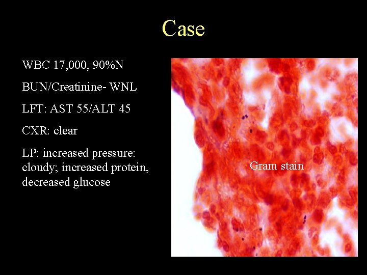 Case WBC 17, 000, 90%N BUN/Creatinine- WNL LFT: AST 55/ALT 45 CXR: clear LP: