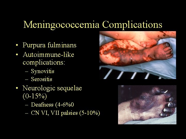 Meningococcemia Complications • Purpura fulminans • Autoimmune-like complications: – Synovitis – Serositis • Neurologic