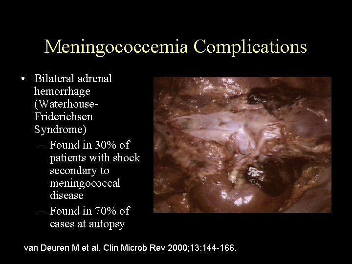 Meningococcemia Complications • Bilateral adrenal hemorrhage (Waterhouse. Friderichsen Syndrome) – Found in 30% of