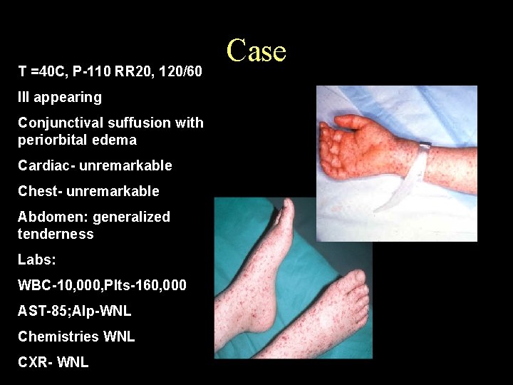 T =40 C, P-110 RR 20, 120/60 Ill appearing Conjunctival suffusion with periorbital edema