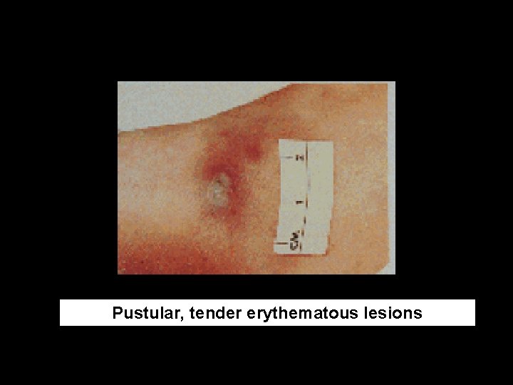 Pustular, tender erythematous lesions 