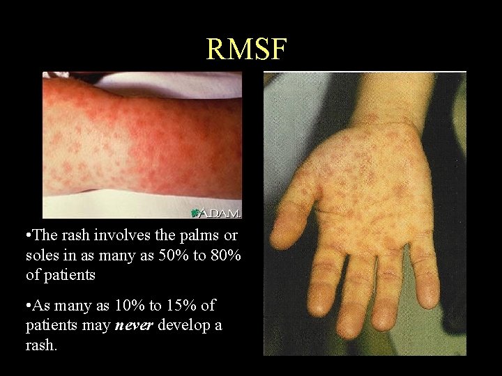 RMSF • The rash involves the palms or soles in as many as 50%