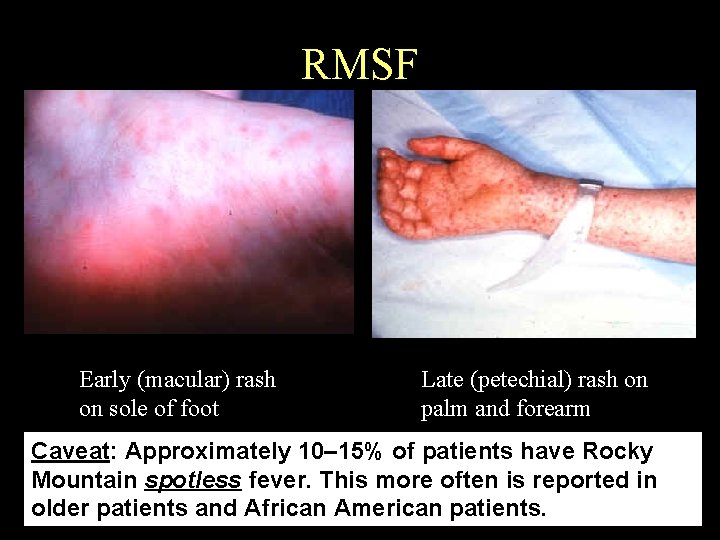 RMSF Early (macular) rash on sole of foot Late (petechial) rash on palm and