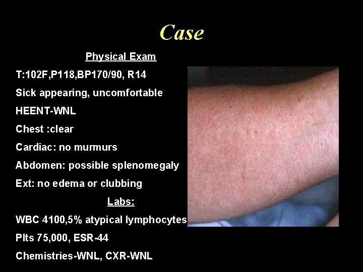 Case Physical Exam T: 102 F, P 118, BP 170/90, R 14 Sick appearing,