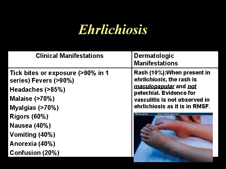 Ehrlichiosis Clinical Manifestations Tick bites or exposure (>90% in 1 series) Fevers (>90%) Headaches