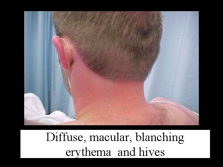 Diffuse, macular, blanching erythema and hives 