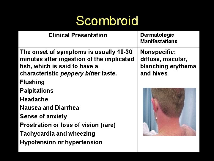 Scombroid Clinical Presentation The onset of symptoms is usually 10 -30 minutes after ingestion