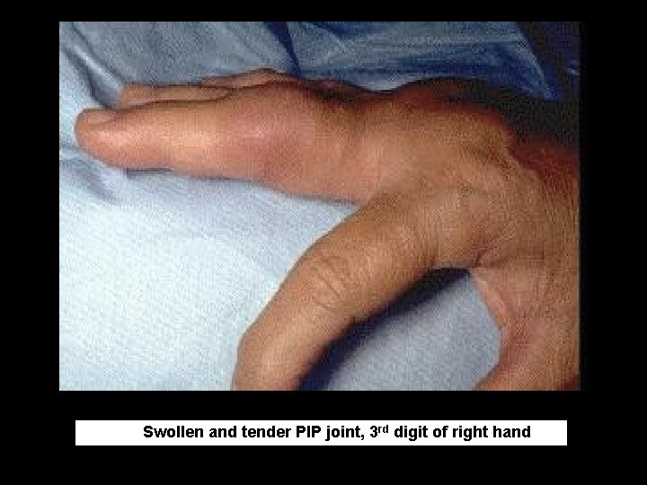 Swollen and tender PIP joint, 3 rd digit of right hand 