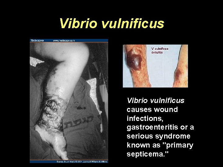 Vibrio vulnificus causes wound infections, gastroenteritis or a serious syndrome known as "primary septicema.