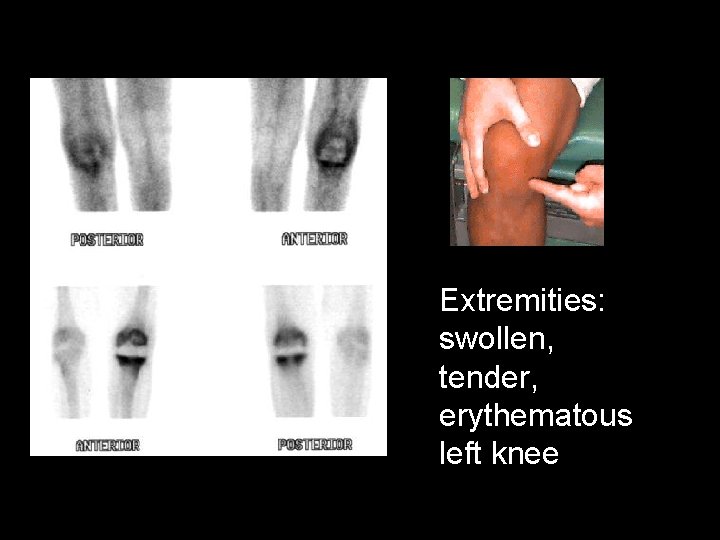 Extremities: swollen, tender, erythematous left knee 