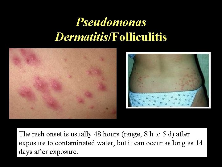 Pseudomonas Dermatitis/Folliculitis The rash onset is usually 48 hours (range, 8 h to 5