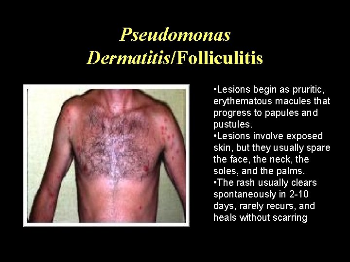 Pseudomonas Dermatitis/Folliculitis • Lesions begin as pruritic, erythematous macules that progress to papules and