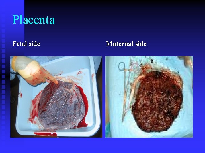 Placenta Fetal side Maternal side Placenta Fetal side Maternal side